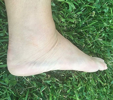 Image of foot before treatment