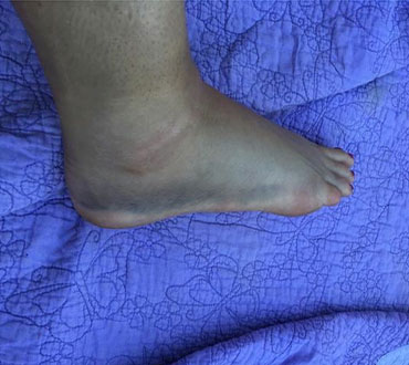 Image of foot before treatment